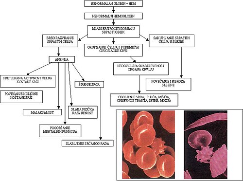 Komparacija normalnih i srpastih eritrocita i moguće posljedice ispoljavanja mutacije HbS