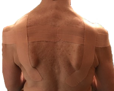 Kinesiology tape applied across the scapulas