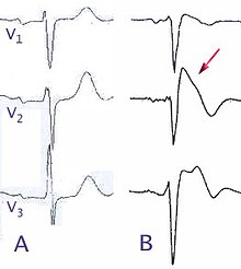 Brugada EKG Schema.jpg