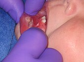 Solitary, large, white to yellow erosion on the inner lower lip of a child