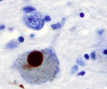 Several brain cells stained in blue. The largest one, a neurone, with a approximately circular form, has a brown circular body inside it. The brown body is about 40% the diameter of the cell in which it appears.