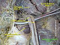 Múscul quadrat femoral