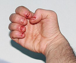 Description de l'image Dermatophagia.jpg.