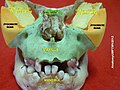 Lesser wing of sphenoid bone