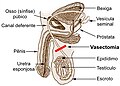 Sistema reprodutor masculino e a indicação da vasectomia (corte do ducto deferente com finalidade contraceptiva).