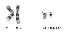 Philadelphias Translution T (9; 22) (Q34; Q11.2) visto in leucemia mielogena cronica.