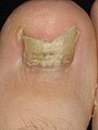 Image 25Onychomycosis (from Fungal infection)