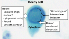 Decoy cell cytology.png