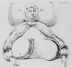 Durston gigantomastia 1670.png