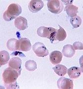 Plasmodium falciparum (Apicomplexa) entre glóbulos rojos.