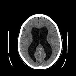 Hydrocephalus.jpg