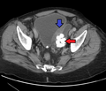 Bladder diverticula containing stones: the bladder wall is thickened due to possible transitional cell carcinoma.