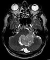 Épendymome du ventricule 4