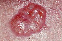 Basal cell carcinoma.jpg