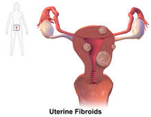 Fibras uterinas