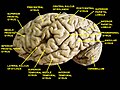 Cervello. Visione laterale. Dissezione profonda. La circonvoluzione temporale superiore è indicata al centro