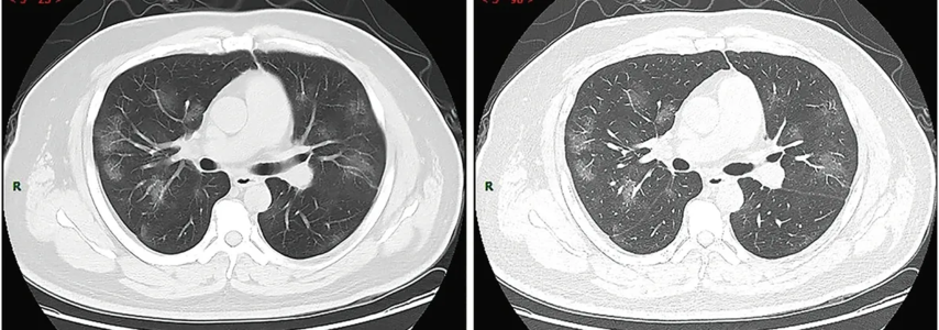 CT-scan van de borstkas van 38-jarige man met COVID-symptomen