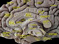 Cerebrum. Medial face. Deep dissection.