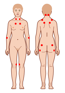 criteria voor fibromyalgie negen gepaarde tenderpoints (1990 American College of Rheumatology criteria for fibromyalgia).