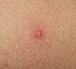 Isolated folliculitis.jpg