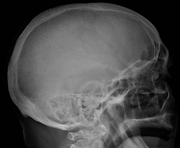 Skull X-ray showing multiple lucencies due to multiple myeloma