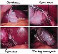 Laparosopic Cholecystectomy