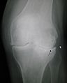 Sol dizin primer osteoartriti. Osteofitlere, eklem boşluğunun daralmasına (ok) ve artmış subkondral kemik yoğunluğuna (ok) dikkat edin.