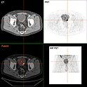 Blasenkrebs in der FDG-PET/CT-Darstellung