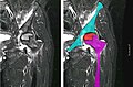 Ressonància magnètica nuclear d'una necrosi asèptica òssia del cap femoral esquerra. Home de 45 anys amb SIDA.