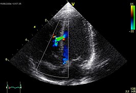 Ventrikelseptumdefect