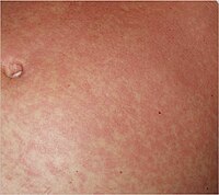 Typical fine-spotted pink rash of acute African trypanosomiasis on the skin of the abdomen ("trypanid rash")[14]