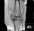 Eklem boşluğunun karakteristik daralması ile dizdeki osteoartrit MRG'si