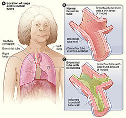 Bronchitis.jpg