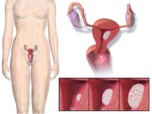 Një skemë e vendndodhjes dhe zhvillimit të kancerit endometrial