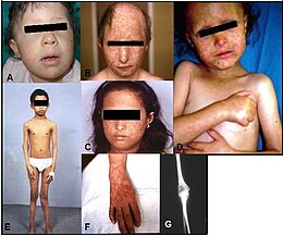 Description de l'image Rothmund-Thomson syndrome.jpg.