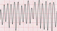 Flutter ventricolare: caratterizzato da onde ampie e sinusoidali con frequenze che oscillano fra i 150 e i 300 batt/min. Tale aritmia necessita di defibrillazione, poiché determina in tempi rapidi una sincope con collasso emodinamico.[56]