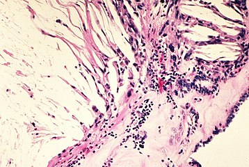 "Cholesterol crystals in tissue usually provoke a foreign body giant cell reaction. This image shows cholesterol extravasated from a ruptured epidermal cyst."