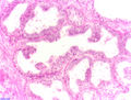 Prostatische intraepitheliale Neoplasie (PIN)