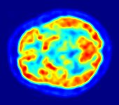 Sagittal PET scan at the level of the striatum. Hottest areas are the cortical grey matter and the striatum.