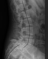 X-ray of a grade 4 anterolisthesis at L5-S1 with spinal misalignment indicated