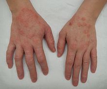 Dermatitis2015.jpg