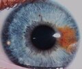 ’n Jong volwassene met sektorale heterochromie in die vorm van ’n oranje segment in haar regteroog. Die indiwidu se moeder het dieselfde vorm van sektorale heterochromie in die linkeroog.