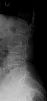 X-ray of the lumbar spine with a compression fracture of the third lumbar vertebra.