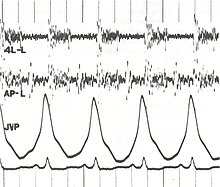 Phonocardiogram.jpg