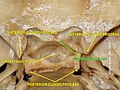 Tuberculum sellae