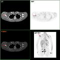 F-18 FDG PET/CT: Ciwon daji na nono metastasis zuwa scapula na dama