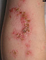 Eingetrocknete Impetigoblasen