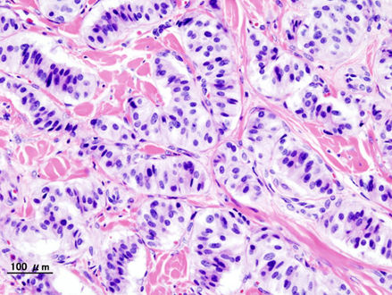 Pancreatic insulinoma