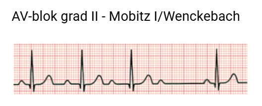 AV-blok grad II - Mobitz I/Wenckebach