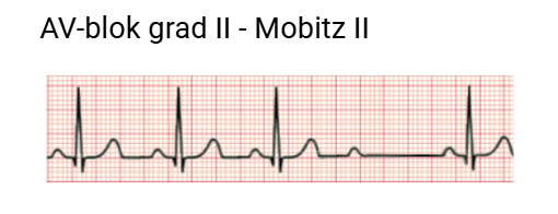 AV-blok grad II - Mobitz II